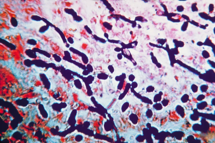 Microscopic view of candida albicans cells showing fungal overgrowth causing vaginal yeast infection.