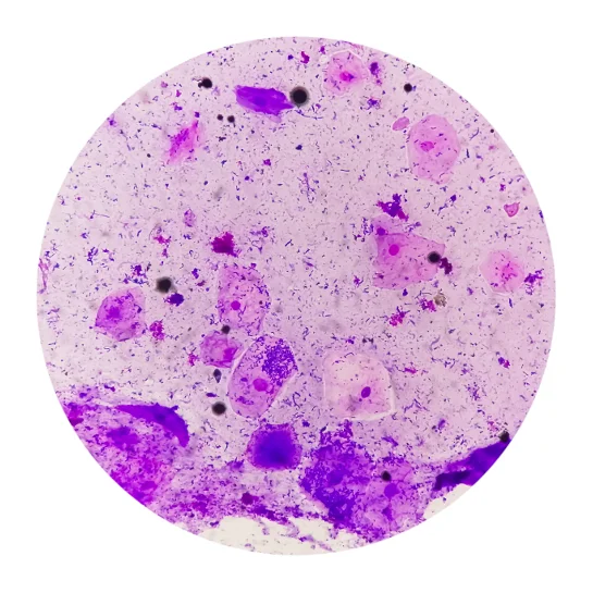Microscopic view of clue cells and bacteria indicating Gardnerella vaginalis infection in BV.