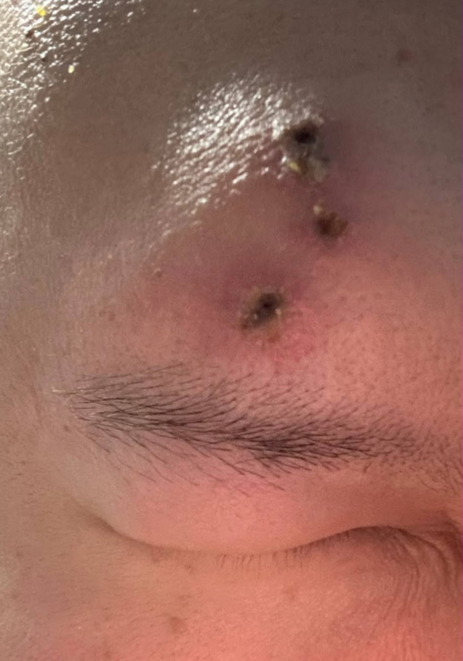 Shingles rash on the forehead with crusted, fluid-filled blisters.